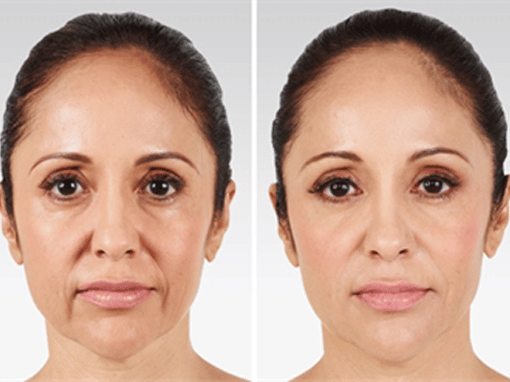 The Importance Of Treating Wrinkles And Sagging Skin In Women